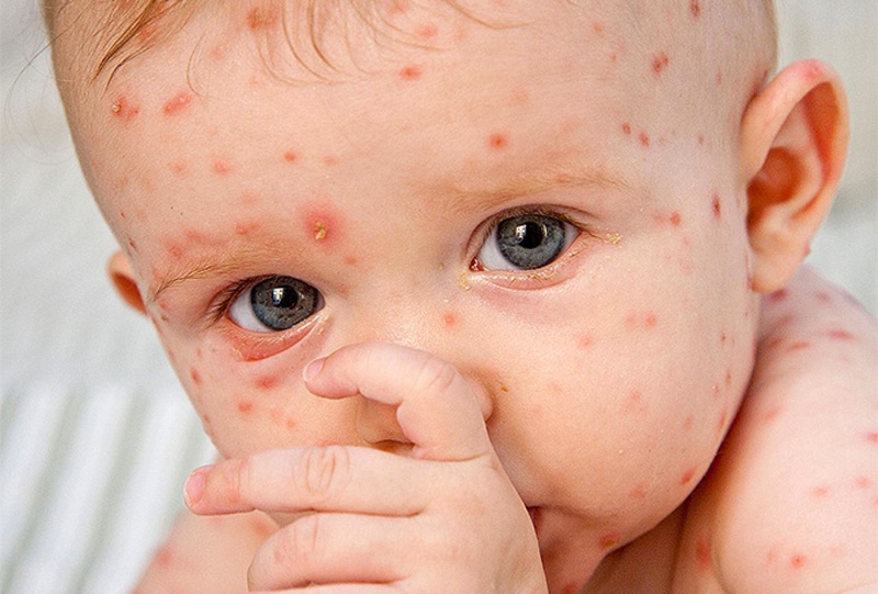 Bí kíp giải nguy làm sao để nhanh hết thủy đậu 1