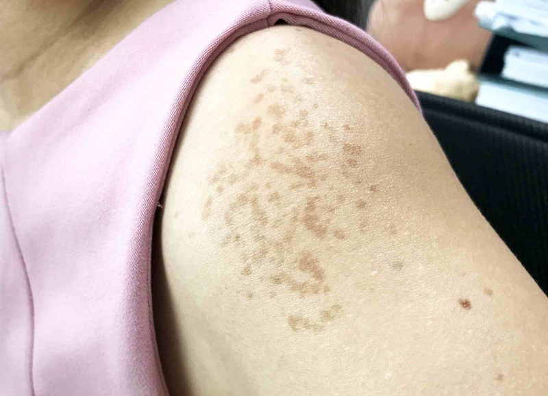 Làm sao để phân biệt giữa nám, tàn nhang, đồi mồi 3
