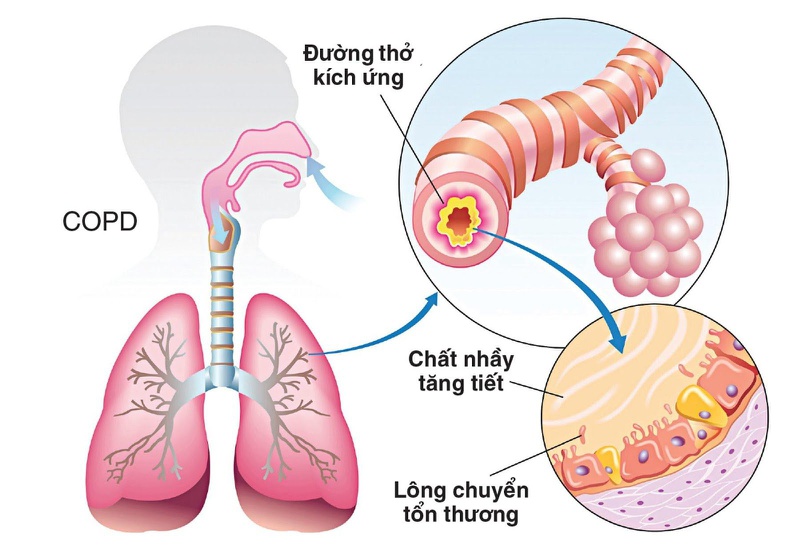 Bệnh phổi tắc nghẽn mạn tính (COPD) là tình trạng đường thở bị thu hẹp làm giảm hô hấp và gây khó thở