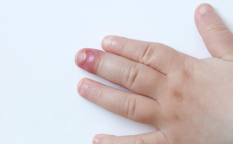 Làm sao để trị tật mút tay cho bé hiệu quả? 3