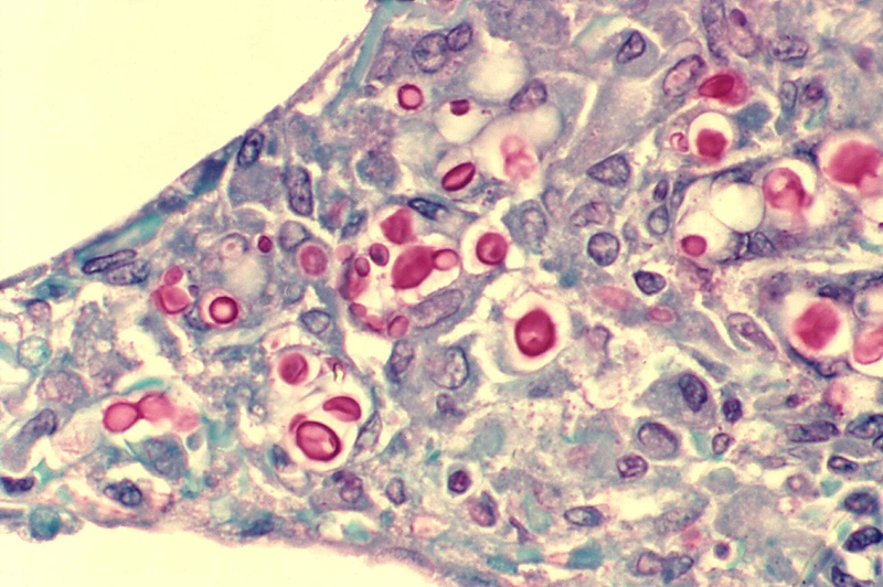 Làm thế nào để nhận biết và điều trị nấm lưỡi HIV 2