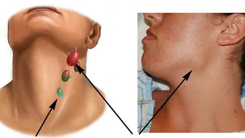 Lao hạch là gì? Chi phí mổ hạch lao có đắt không 1