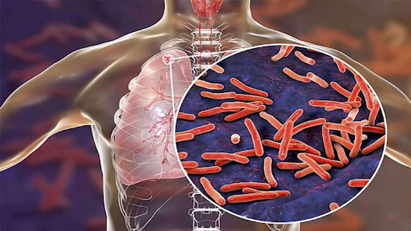 Giải đáp thắc mắc: Lao màng não có chữa được không 1