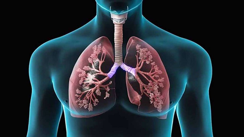 Lao phổi là gì