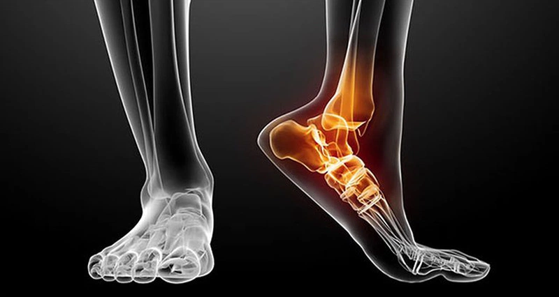 chụp x quang giúp chẩn đoán chấn thương cổ chân