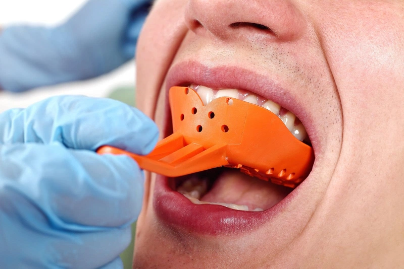 Lấy dấu răng khi niềng để làm gì? Quy trình niềng răng cụ thể? 2