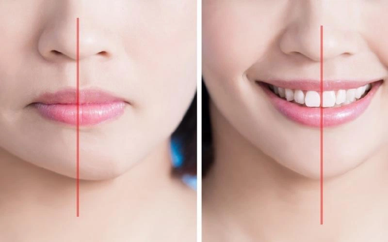 Tập Mewing có cải thiện mặt lệch không? 2