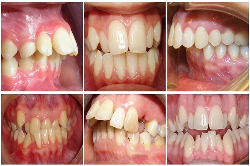 Lệch khớp cắn là tình trạng lệch tâm giữa răng hàm trên với răng hàm dưới
