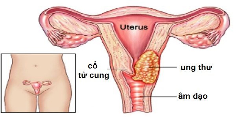Lên lịch tiêm phòng ung thư cổ tử cung ngay hôm nay vì sức khỏe của bạn