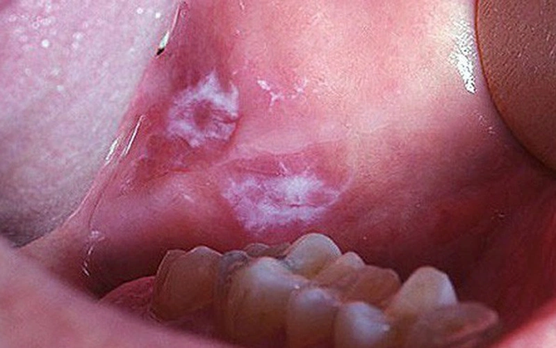 Lichen phẳng và cách chữa nhanh để ngăn ngừa nguy cơ ung thư miệng