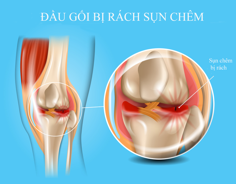 Liệu rách sụn chêm đầu gối có nguy hiểm không2