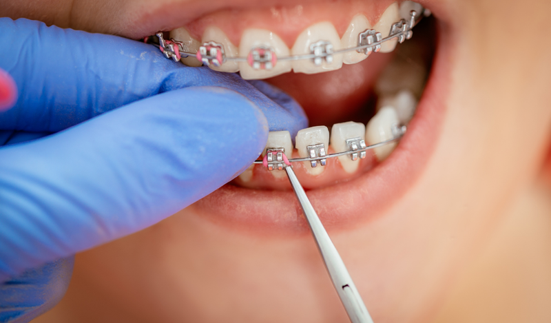 Cách khắc phục tình trạng răng thưa
