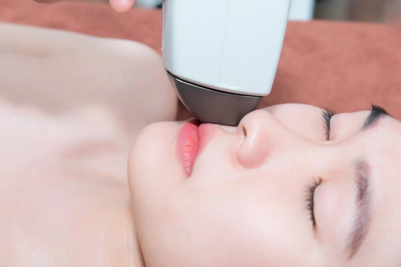 Liệu trình triệt ria mép hết bao nhiêu tiền? 2