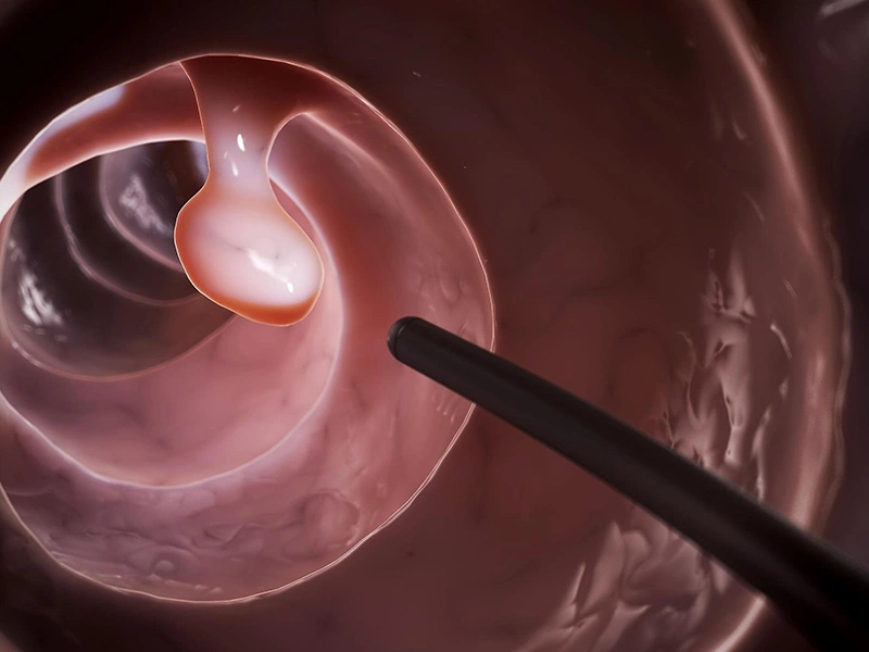 Liệu xoắn polyp cổ tử cung khi mang thai có nguy hiểm không? 3