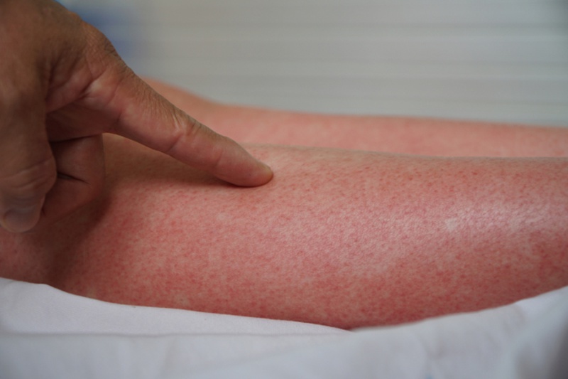 Cách phân biệt sự khác nhau của sốt phát ban và sốt xuất huyết
