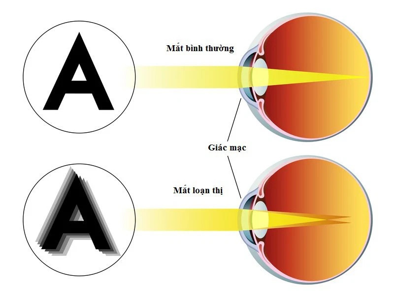 Bị loạn thị có đi nghĩa vụ quân sự không? 1