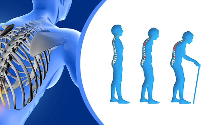 Những điều cần biết về loãng xương sau điều trị ung thư vú 1