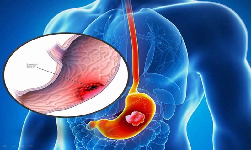 Những điều nhất đinh phải biết về bệnh loét dạ dày tá tràng 1