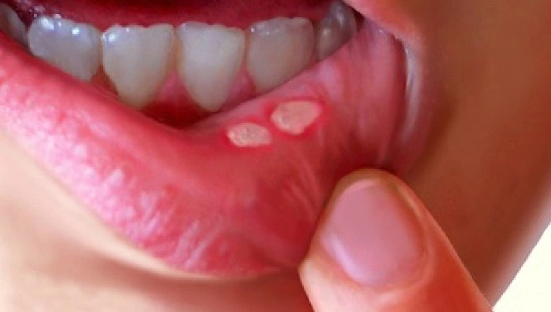 Loét miệng có lây không và cách chữa trị nhanh chóng