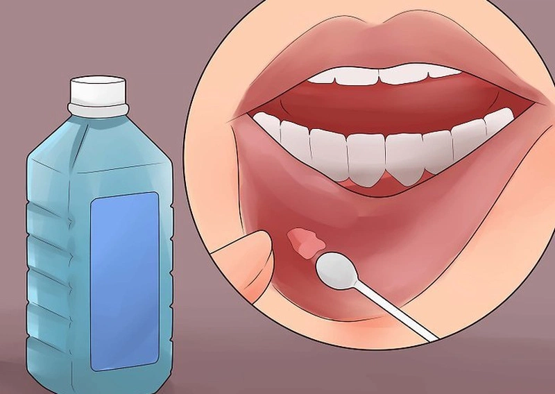 Loét miệng có lây không và cách chữa trị nhanh chóng