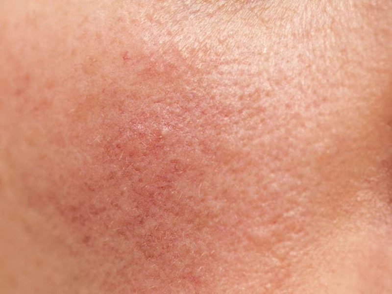 Loét tỳ đè ở người bệnh ung thư1
