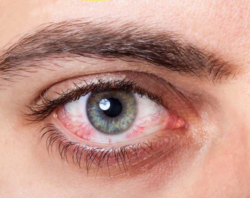 Lòng trắng mắt có nhiều tia máu đỏ có nguy hiểm không?
