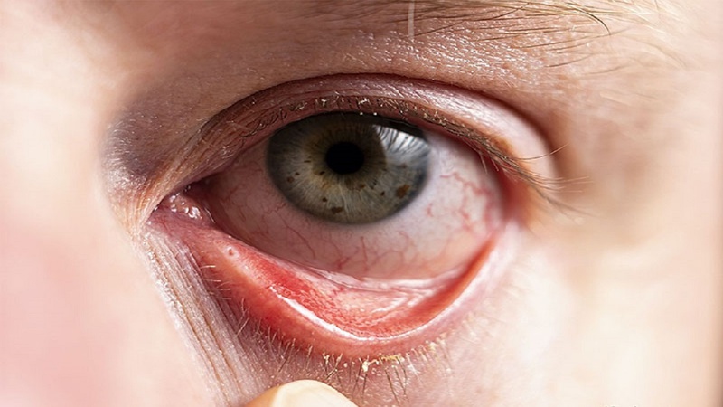 Lòng trắng mắt có nhiều tia máu đỏ có nguy hiểm không?