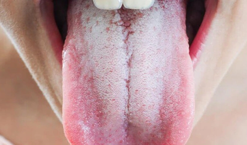Lưỡi bị trắng đóng bợn