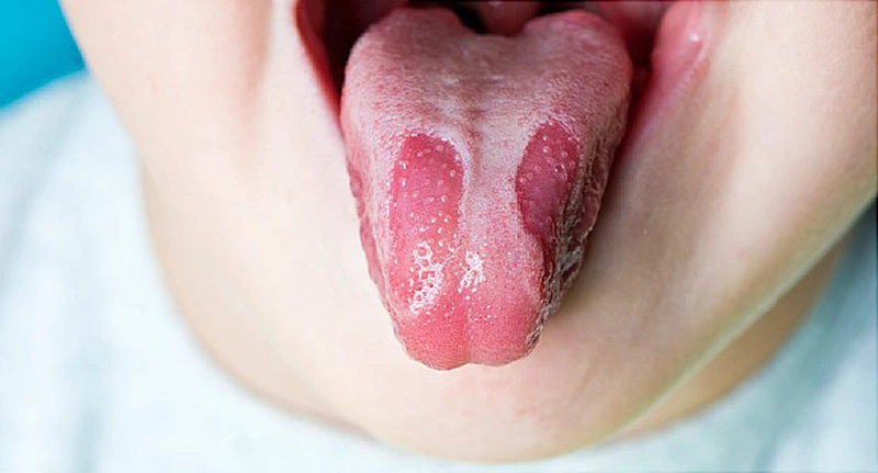 Lưỡi địa lý là gì? Dấu hiệu nhận biêt và cách điều trị hiệu quả tại nhà