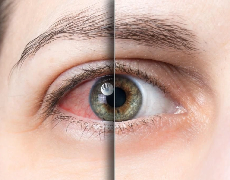 Lupus ban đỏ ảnh hướng đến mắt bạn như thế nào? 2