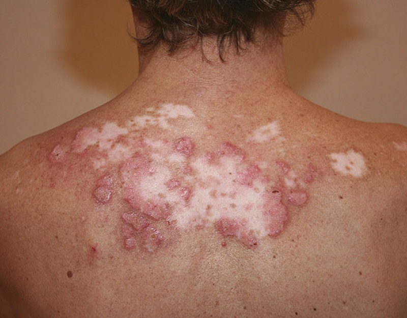Lupus ban đỏ có gây đau khớp không? 1