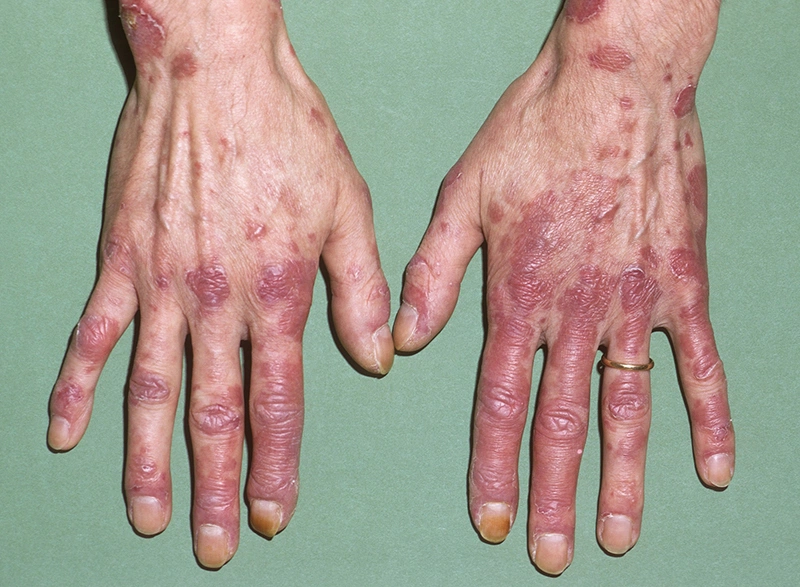Lupus ban đỏ có mấy loại? Biến chứng của lupus ban đỏ nguy hiểm như thế nào? 1