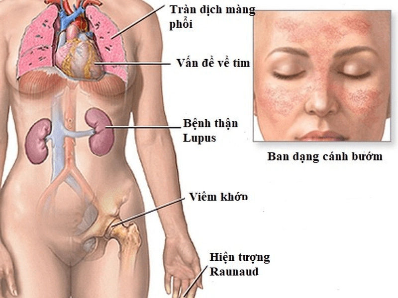 Lupus ban đỏ có mấy loại? Biến chứng của lupus ban đỏ nguy hiểm như thế nào? 2