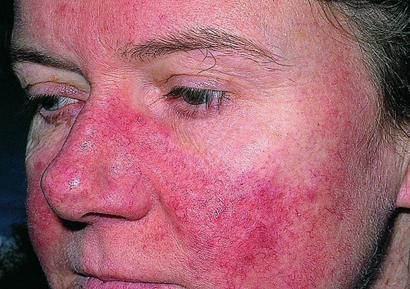Lupus ban đỏ có mấy loại? Biến chứng của lupus ban đỏ nguy hiểm như thế nào? 3
