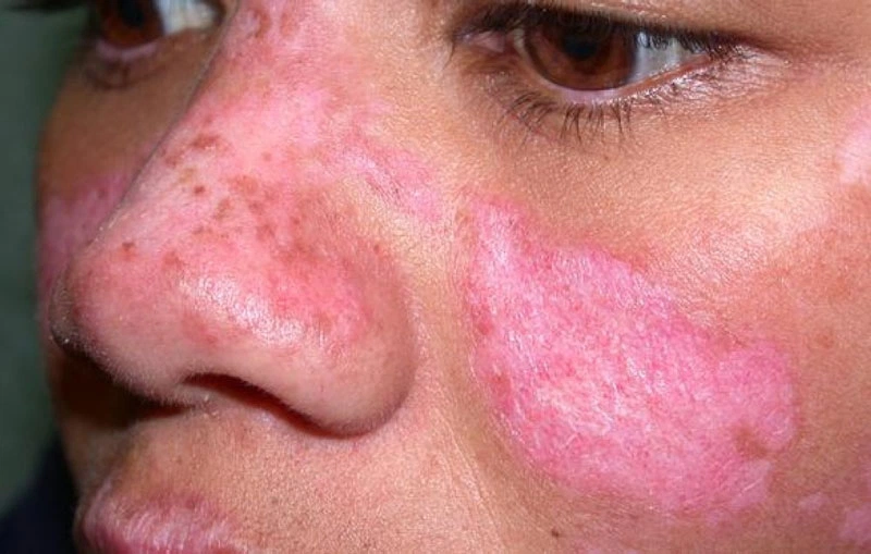 Lupus ban đỏ dạng đĩa có ngứa không? 3