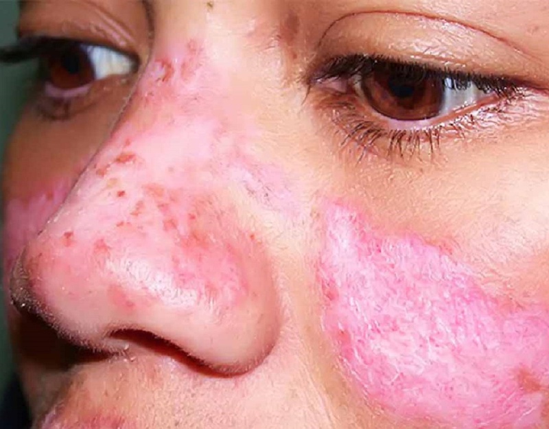 Lupus ban đỏ khi mang thai có nguy hiểm không? 1