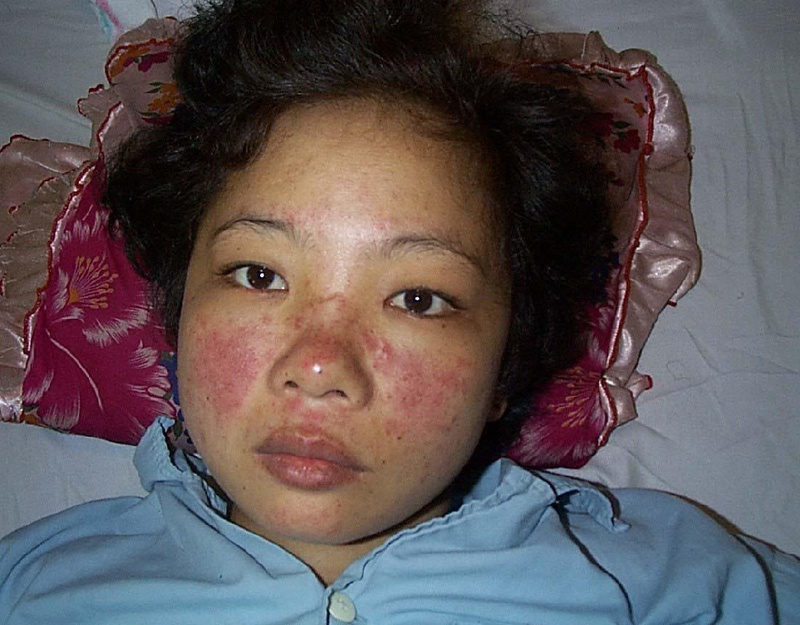 Lupus ban đỏ khi mang thai có nguy hiểm không? 2