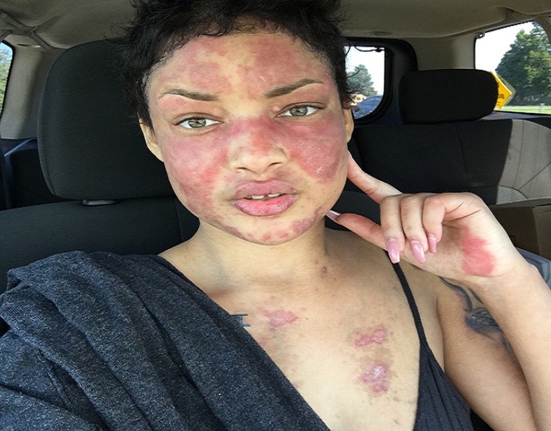 Lupus ban đỏ miễn dịch có nguy hiểm không? Làm sao để giảm căng thẳng khi mắc bệnh 1
