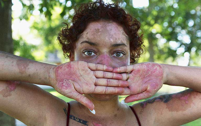 Lupus ban đỏ miễn dịch có nguy hiểm không? Làm sao để giảm căng thẳng khi mắc bệnh 2