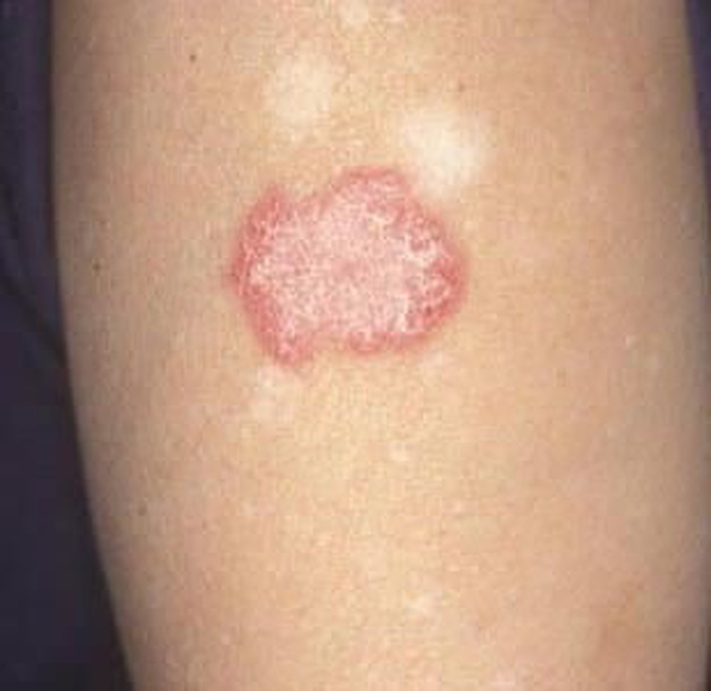 Lupus ban đỏ ở chân: Triệu chứng, nguyên nhân và phương pháp chữa trị 1