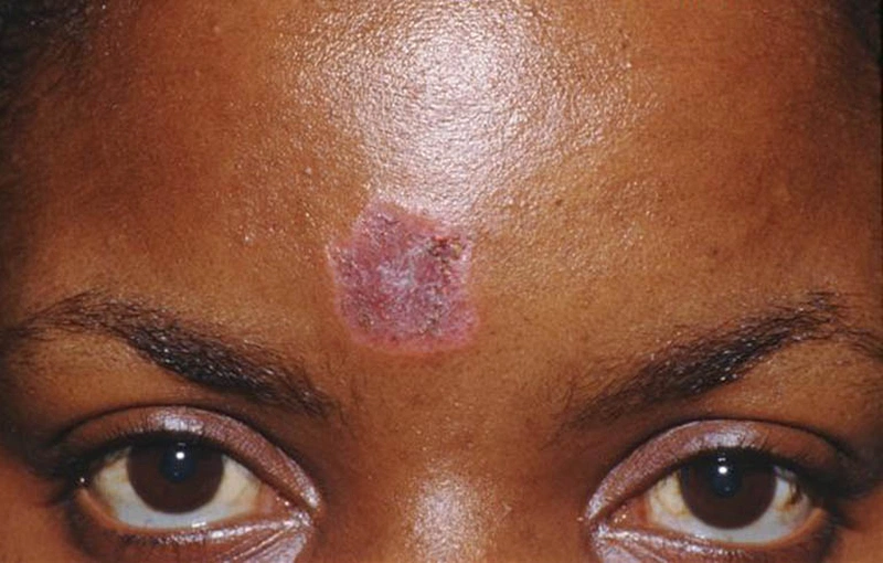 Lupus ban đỏ ở mặt có các dạng tổn thương nào? Chế độ dinh dưỡng cần thiết cho người mắc bệnh lupus ban đỏ 1
