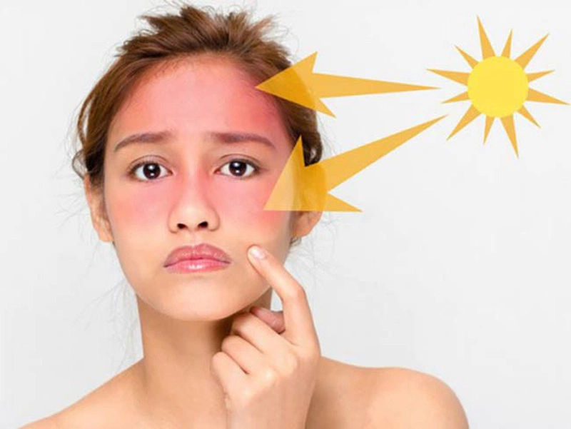 Lupus ban đỏ ở mặt có các dạng tổn thương nào? Chế độ dinh dưỡng cần thiết cho người mắc bệnh lupus ban đỏ 2