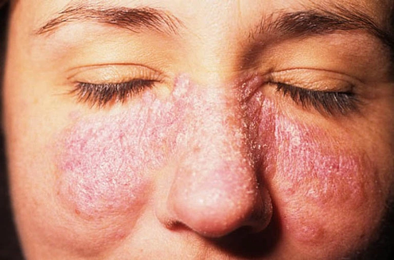 Lupus ban đỏ tái phát có thể điều trị khỏi không? Đối tượng nào có nguy cơ mắc bệnh lupus ban đỏ