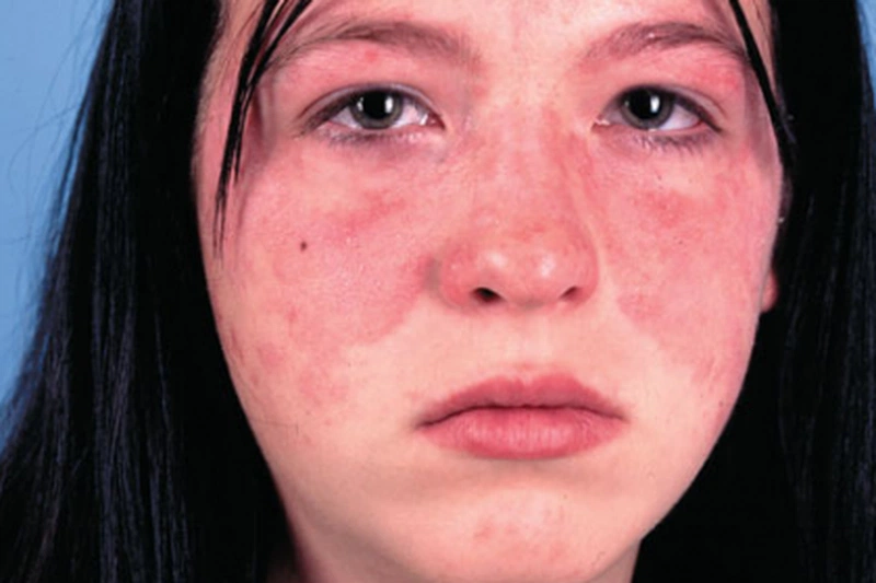 Lupus ban đỏ và vảy nến: Tổng quan và các triệu chứng 2