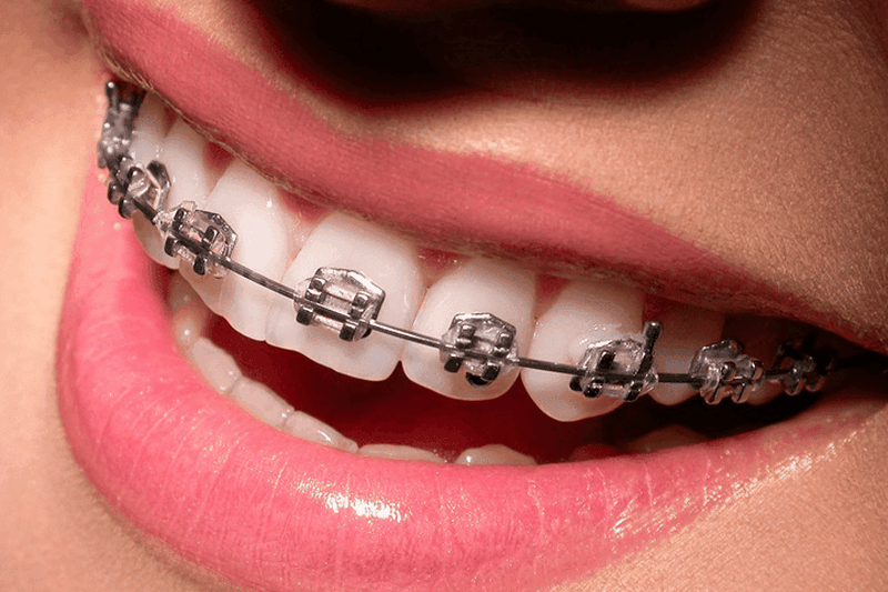 Giải đáp thắc mắc niềng răng có thay đổi giọng nói không? 3
