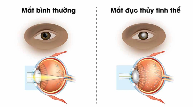 Mách bạn 5 cách bảo vệ mắt giúp tăng cường thị lực 2