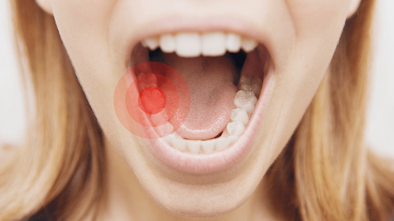 Có nhiều nguyên nhân gây đau răng hàm như sâu răng, viêm tủy, mọc răng khôn,...