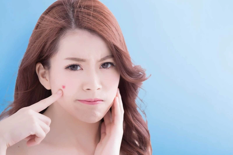 Mách bạn cách hết mụn nhanh nhất chỉ sau một đêm