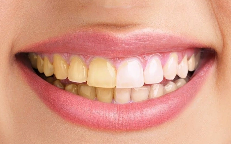 Mách bạn cách trị chân răng bị đen tại nhà dễ làm mà hiệu quả 2