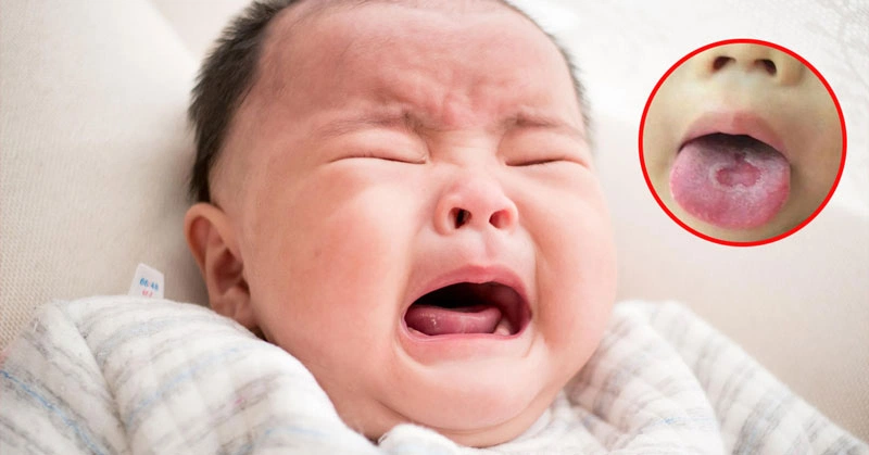 Mách bạn những cách điều trị nấm họng ở trẻ em 1